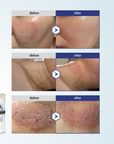 AESTHEIN All-Skin 4GF Supreme Plumping Essence 50ml before and after comparison shot