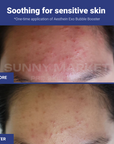 Before and after using AESTHEIN Exo Bubble Booster – visible soothing effect on sensitive skin after one-time application