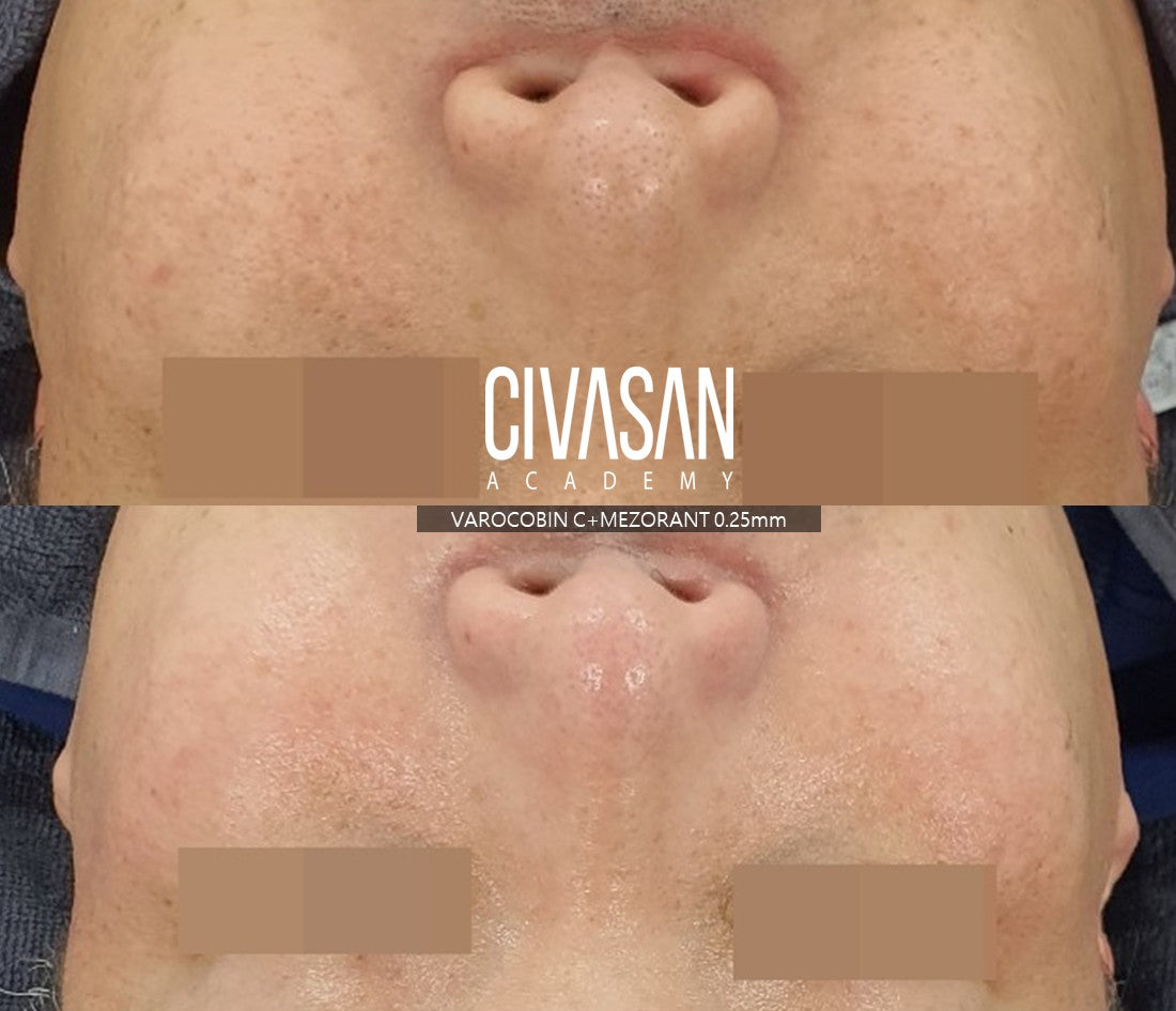 [CIVASAN] Varocobin C Professional Kit 시바산 비타민C 키트