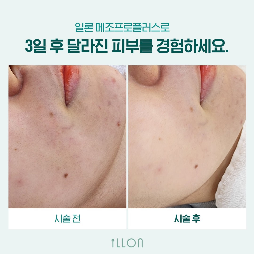 [ILLON] MESOPRO+ 일론 메조프로 플러스