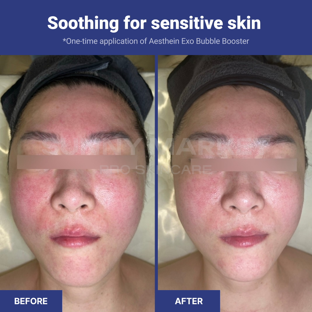 Before and after using AESTHEIN Exo Bubble Booster – visible soothing effect on sensitive skin after one-time application