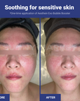 Before and after using AESTHEIN Exo Bubble Booster – visible soothing effect on sensitive skin after one-time application