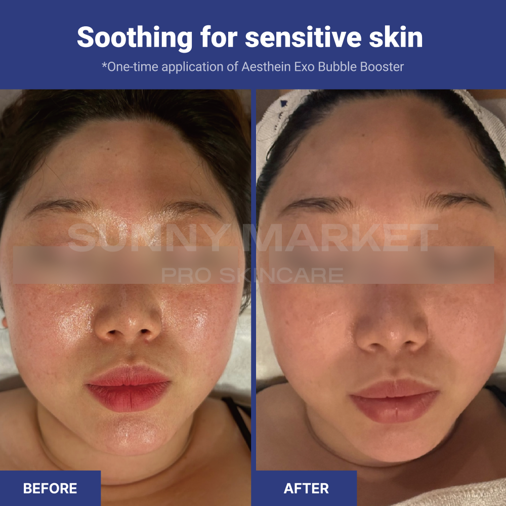 Before and after using AESTHEIN Exo Bubble Booster – visible soothing effect on sensitive skin after one-time application