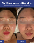 Before and after using AESTHEIN Exo Bubble Booster – visible soothing effect on sensitive skin after one-time application