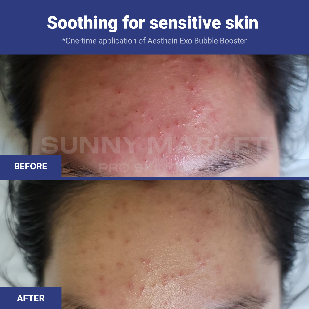 Before and after using AESTHEIN Exo Bubble Booster – visible soothing effect on sensitive skin after one-time application